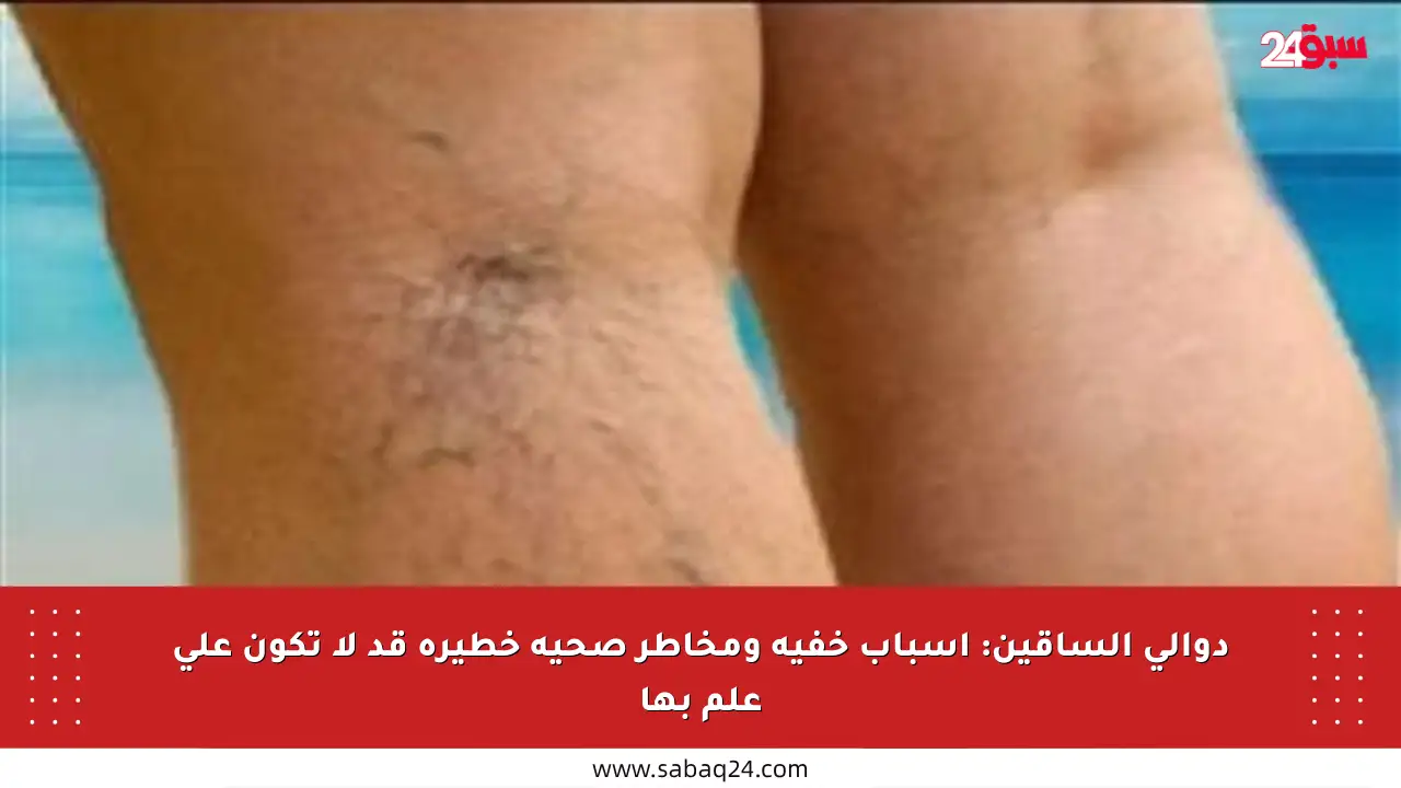 دوالي الساقين: أسباب خفية ومخاطر صحية خطيرة قد لا تكون على علم بها